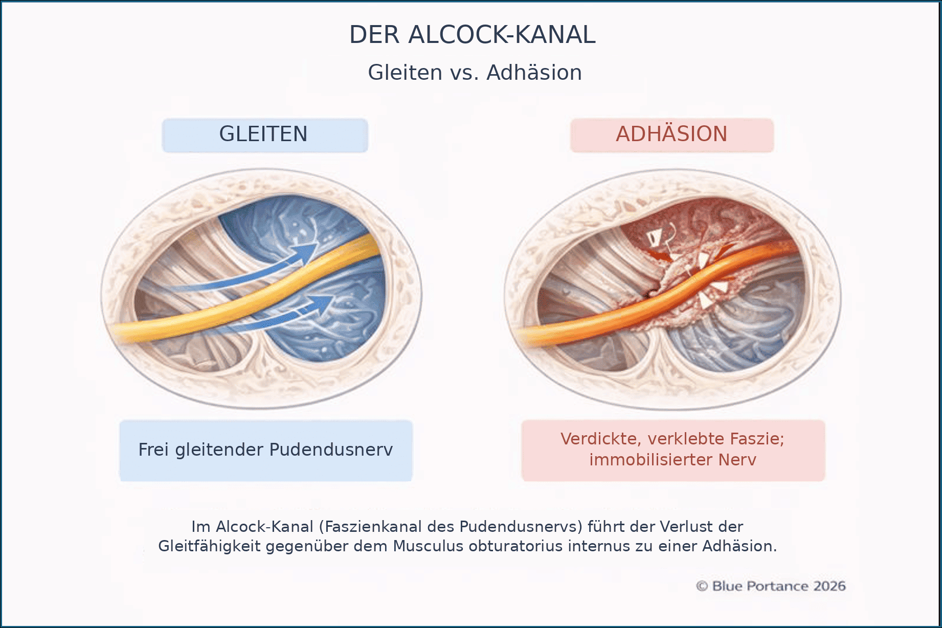 Alcock-Kanal und Faszien: Vergleich zwischen freiem Gleiten des Pudendusnervs und eingeschränkter Beweglichkeit durch verhärtete Faszien.