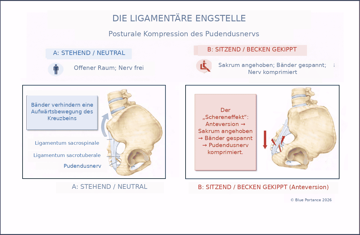 Ligamentäre Engstelle des Pudendusnervs zwischen Ligamentum sacrospinale und Ligamentum sacrotuberale als Darstellung einer haltungsbedingten Kompression.