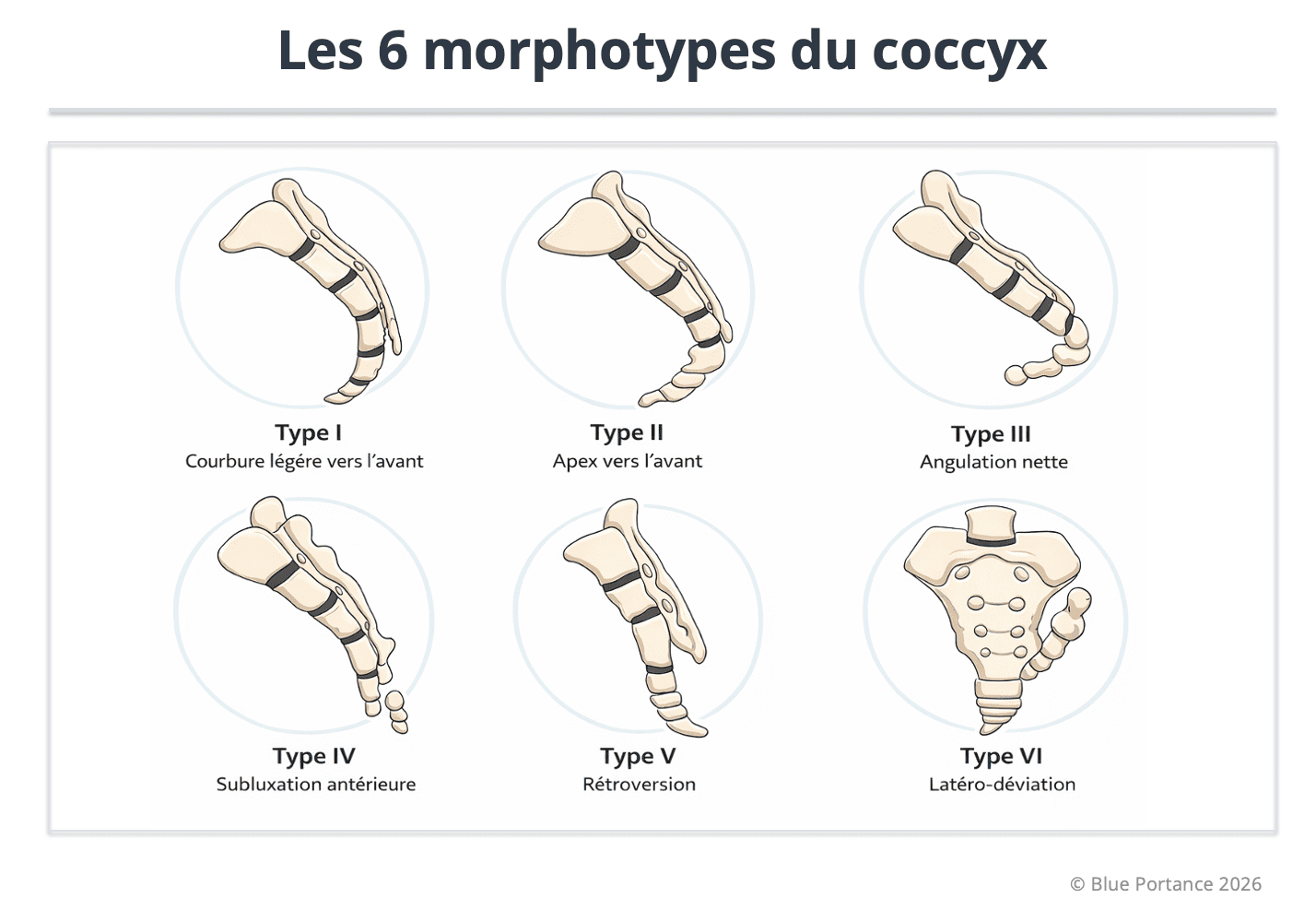 Les six morphotypes du coccyx (types I à VI) : variations de courbure, d’angulation, de subluxation, de rétroversion et de déviation latérale