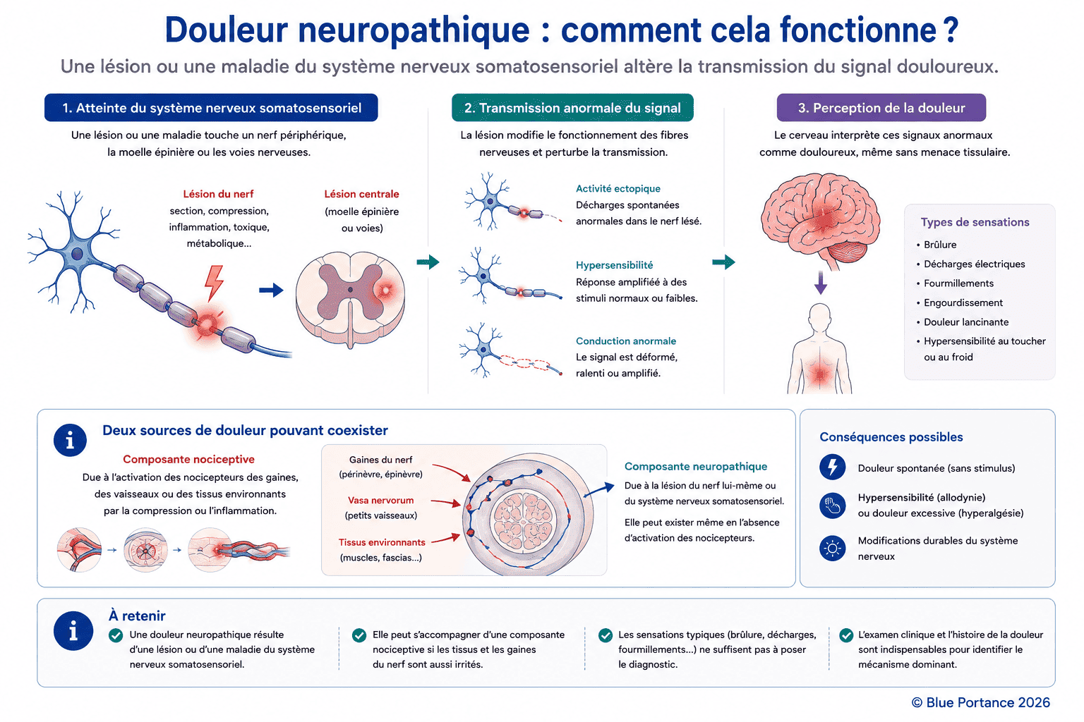 Schéma de la douleur neuropathique montrant une atteinte du système nerveux somatosensoriel, une transmission anormale du signal et la coexistence possible de composantes nociceptive et neuropathique.