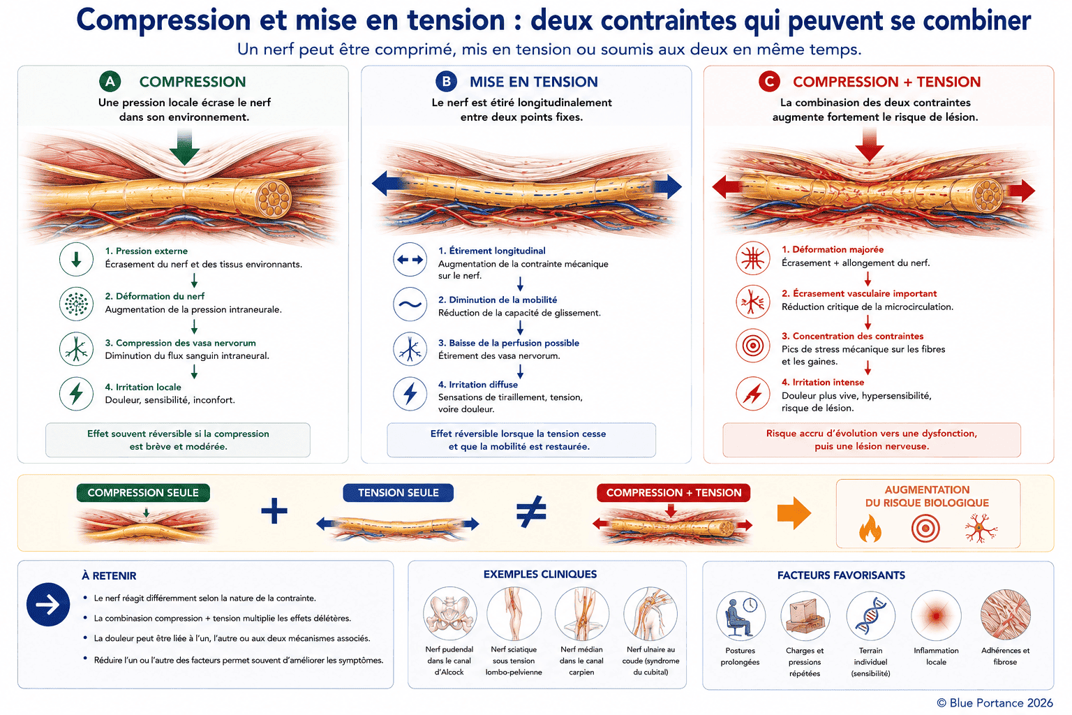 Comparaison entre une compression nerveuse, une mise en tension du nerf et leur association montrant l'augmentation des contraintes mécaniques et du risque biologique.
