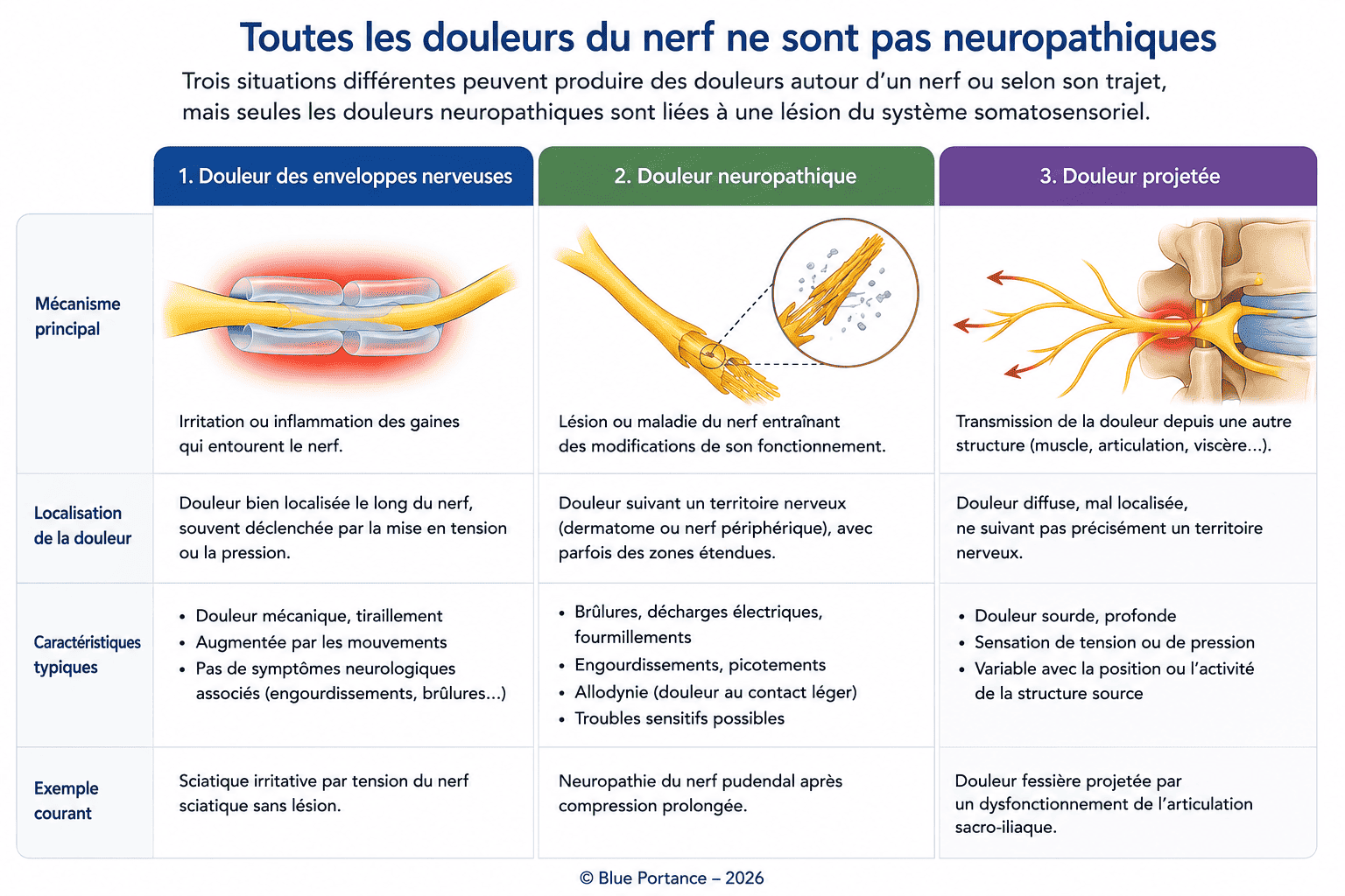 Schéma comparant les douleurs des enveloppes nerveuses, les douleurs neuropathiques et les douleurs projetées.