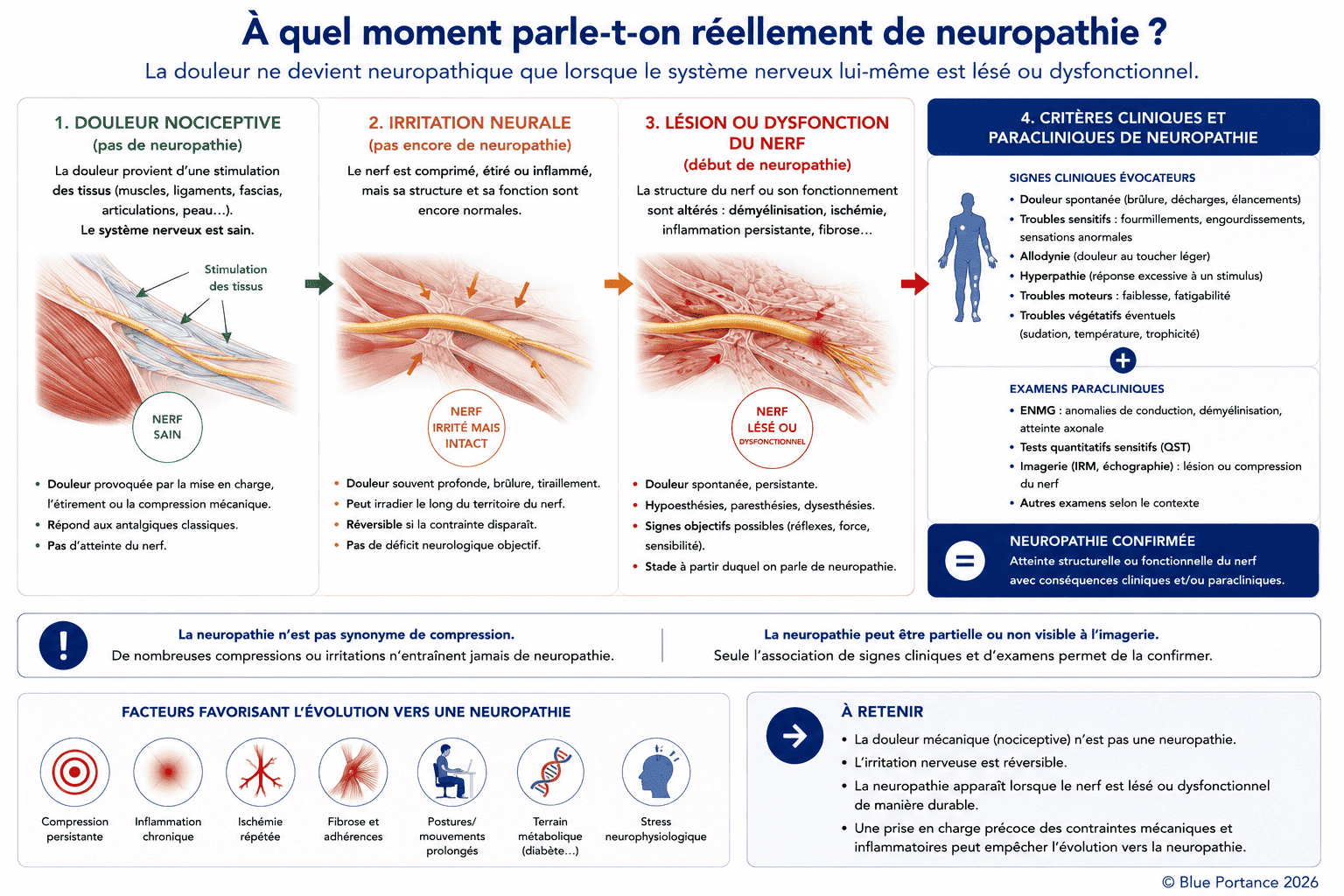 Schéma expliquant la transition entre douleur nociceptive, irritation neurale et véritable neuropathie avec les principaux critères diagnostiques.