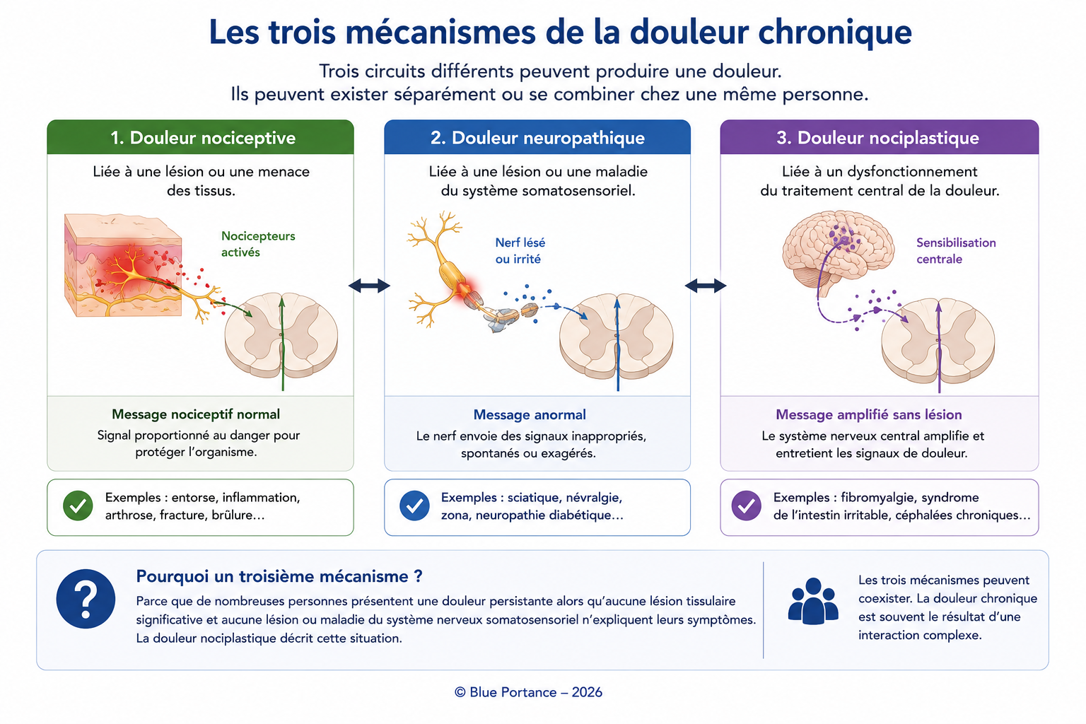 Schéma présentant les trois mécanismes de la douleur chronique : nociceptive, neuropathique et nociplastique.