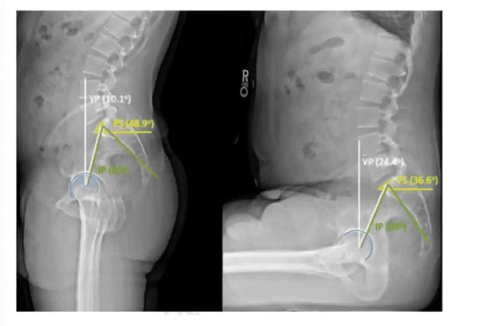 Radiographie comparative debout et assis : modification de la version pelvienne