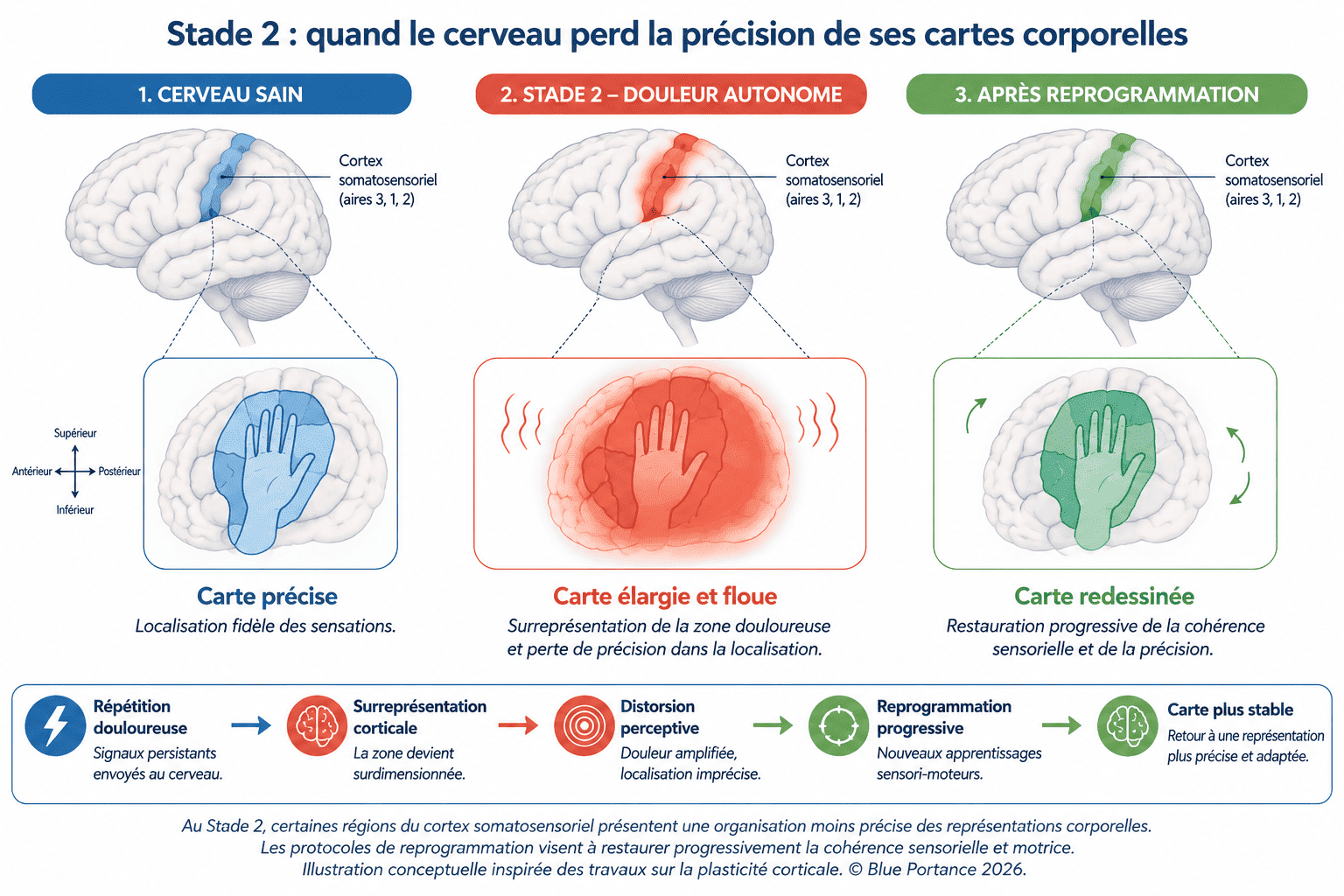 Trois états du cortex somatosensoriel : cerveau sain avec carte précise, Stade 2 avec zone élargie et floue, après reprogrammation avec carte redessinée et cohérente